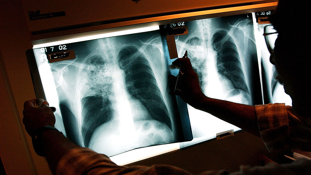 2 active tuberculosis cases traced to San Francisco strip club — KTVU FOX 2 Bay Area, Atherton Health news